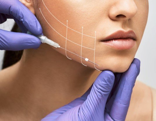 After Thread Lift